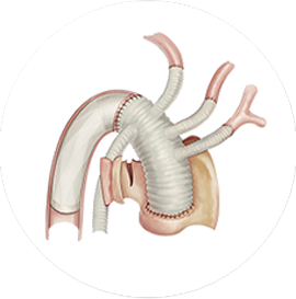 CRONUS™ Stent Graft System in Surgical Operation